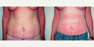 Liposuction before and after photo