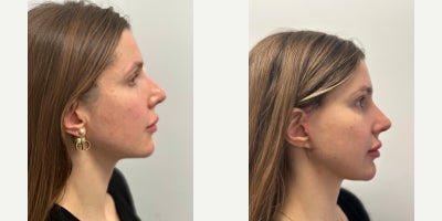 MACS Facelift before and after photo