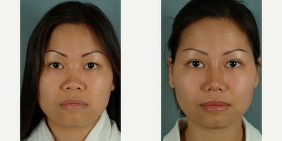 Rhinoplasty before and after photo