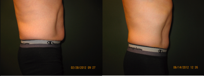 CoolSculpting before and after photo