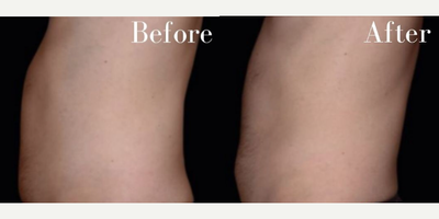 Emsculpt before and after photo
