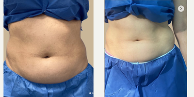 Emsculpt before and after photo