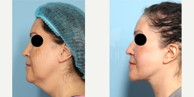 Facelift before and after photo