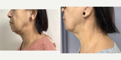 Radiesse before and after photo