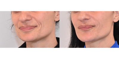 Restylane Refyne before and after photo