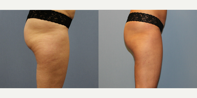 Cellfina before and after photo