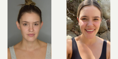 Earfold before and after photo