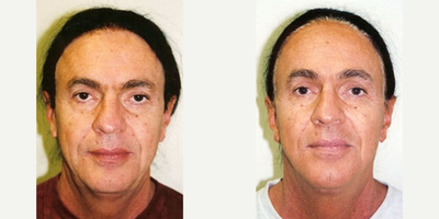 Facelift before and after photo