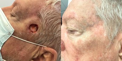 Mohs Surgery before and after photo