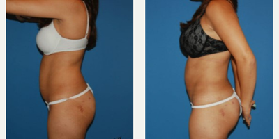 SculpSure before and after photo