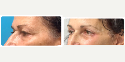 Eyelid Surgery before and after photo