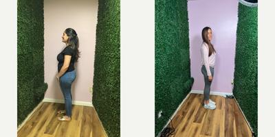 Gastric Balloon before and after photo