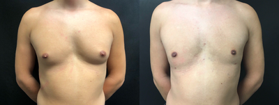 Gynecomastia Surgery before and after photo