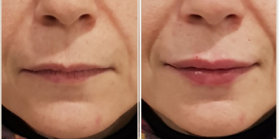 Juvederm before and after photo