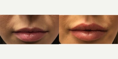 Lip Fillers before and after photo