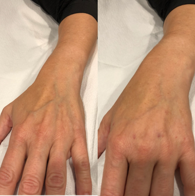 Radiesse before and after photo