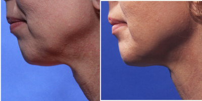 ThermiTight before and after photo