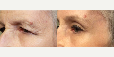 Brow Lift before and after photo