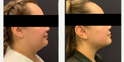 Chin Liposuction before and after photo