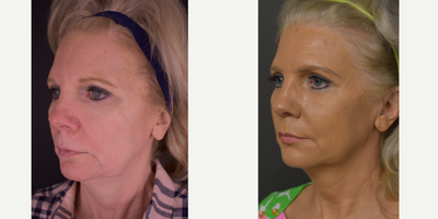 CO2 Laser before and after photo
