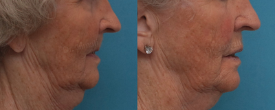 Dental Bone Graft before and after photo