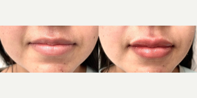 Dermal Fillers before and after photo