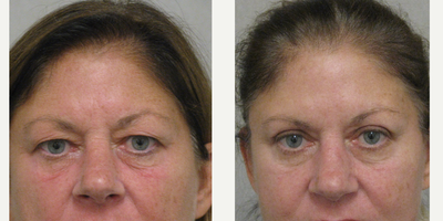 Eyelid Surgery before and after photo