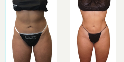 Liposculpture before and after photo