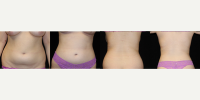 Liposuction before and after photo