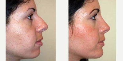 Rhinoplasty before and after photo