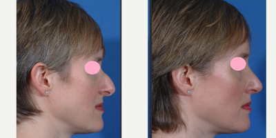 Rhinoplasty before and after photo