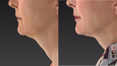 Ultherapy before and after photo