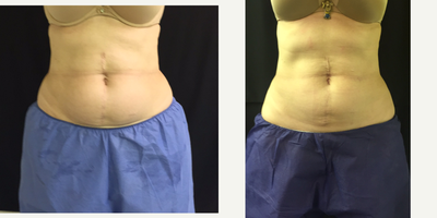 CoolSculpting before and after photo