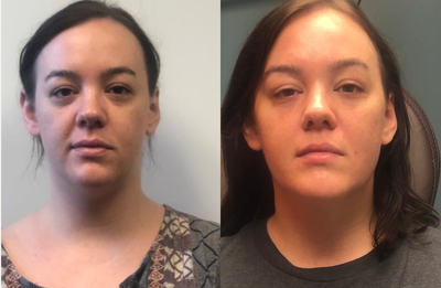 Eyelid Surgery before and after photo