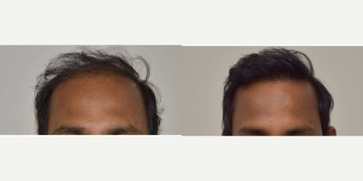 FUE Hair Transplant before and after photo