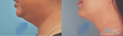 Kybella before and after photo