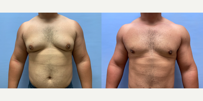 Gynecomastia Surgery before and after photo