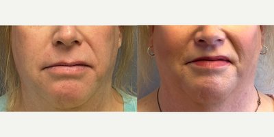 before and after image