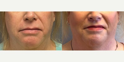 Lip Surgery before and after photo