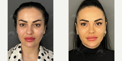 Rhinoplasty before and after photo