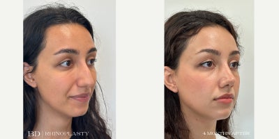 Rhinoplasty before and after photo