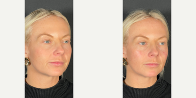 Voluma before and after photo