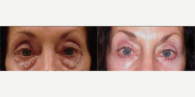Brow Lift before and after photo