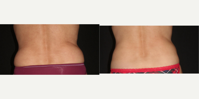 CoolSculpting before and after photo