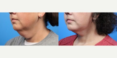 Facelift before and after photo