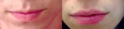 Juvederm before and after photo