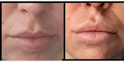 Lip Fillers before and after photo