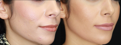 Vivace before and after photo