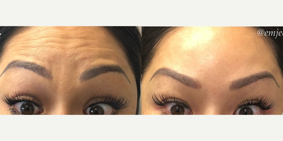 Botox before and after photo