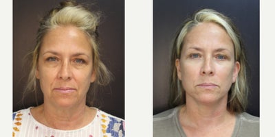 Eyelid Surgery before and after photo